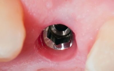 Comment se déroule la pose d&rsquo;un implant dentaire ?