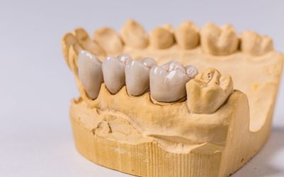Les différentes prothèses dentaires