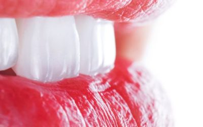 Qu&rsquo;est ce qu&rsquo;une facette dentaire ?