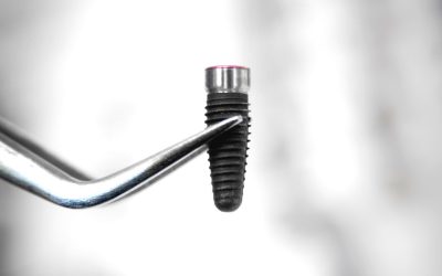 L&rsquo;implant dentaire, rentable à terme.