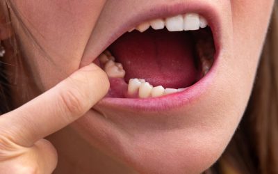 Doit on conserver ou non sa dent ?