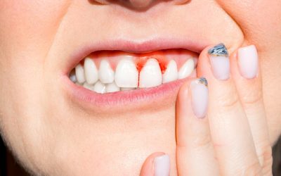 Tout savoir sur la maladie parodontale