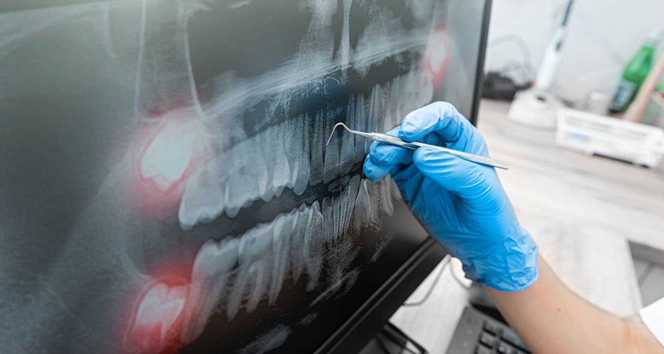 Greffes osseuses implantologie toulouse