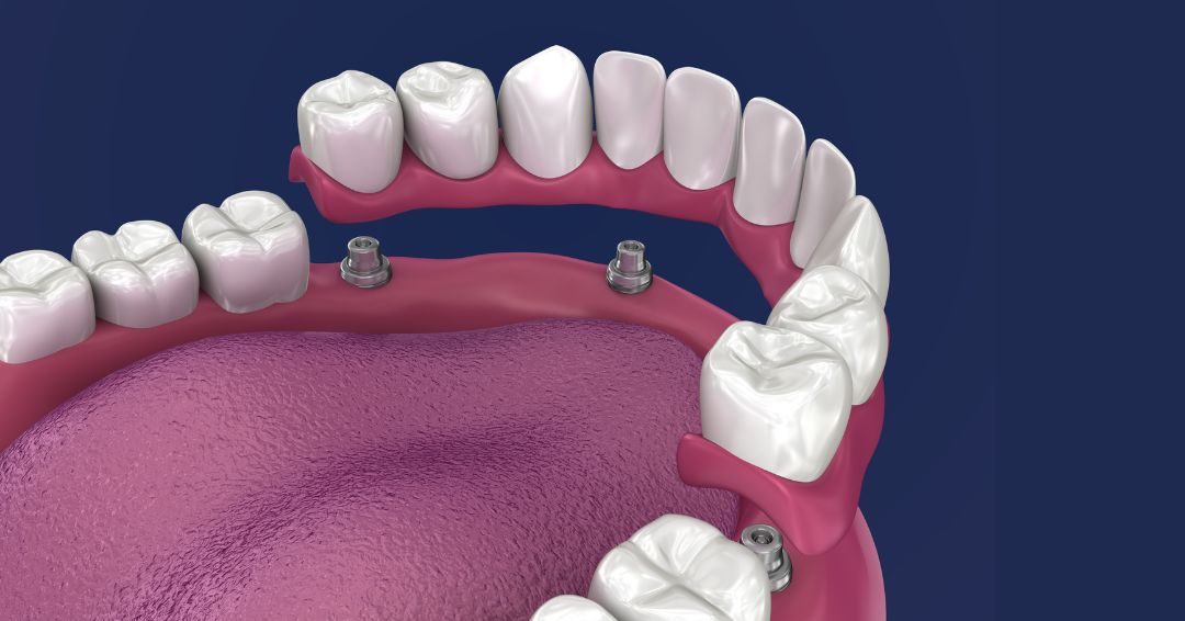 All-On-4 et implants dentaires
