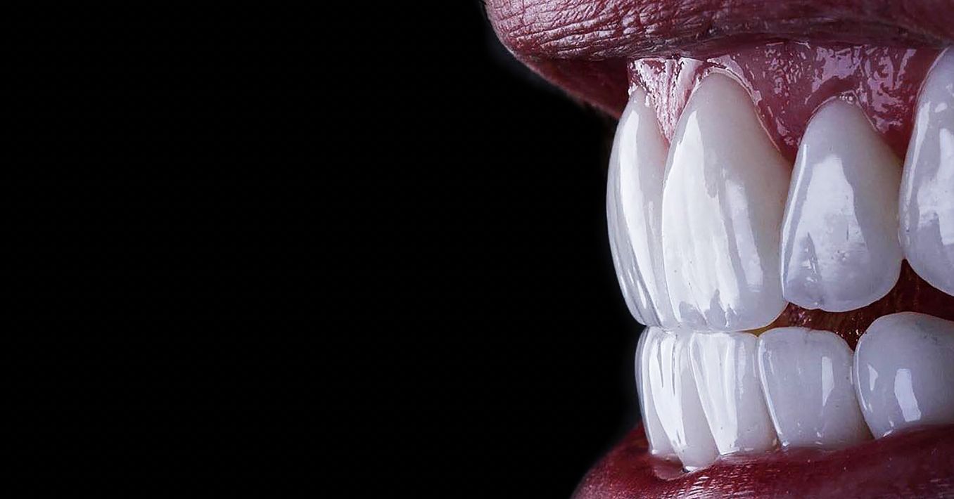 Tout Savoir sur les facettes dentaires