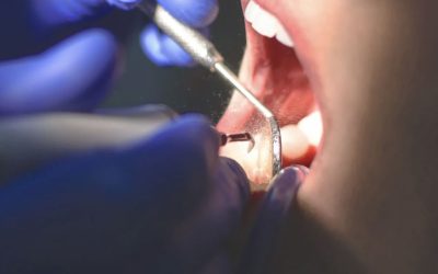 10 questions fréquentes sur les implants dentaires et la parodontologie