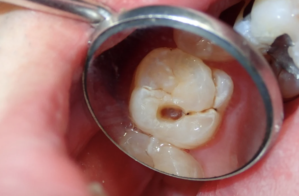 La prévention des caries dentaires