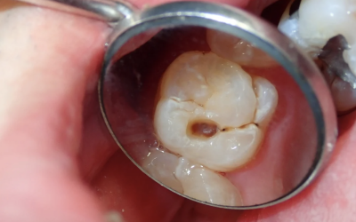 La prévention des caries dentaires : stratégies et innovationsmodernes