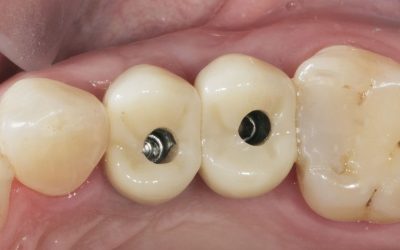 Implants dentaires : le guide complet pour restaurer votre sourire