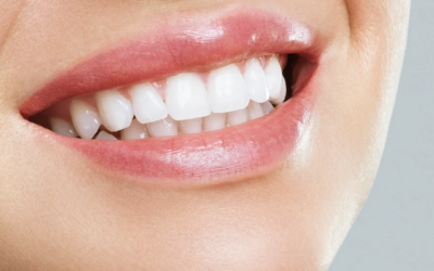 Le blanchiment dentaire à Toulouse : retrouvez un sourire éclatant