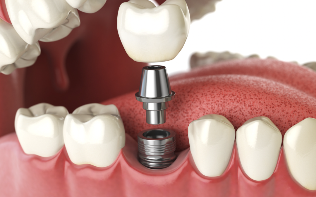 implants dentaires ou bridge dentaire