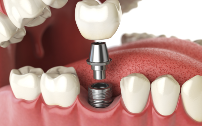 Implants dentaires ou bridge dentaire : quel choix est le plus adapté ?