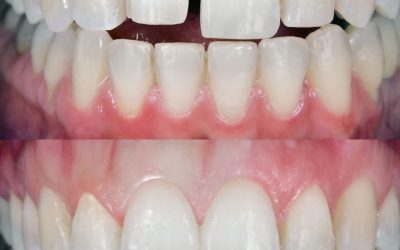 LES SOLUTIONS ESTHÉTIQUES POUR UN SOURIRE ÉCLATANT : FACETTES, BLANCHIMENT ET AUTRES OPTIONS