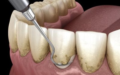 Les nouvelles avancées en matière de traitements de la parodontite : Ce que vous devez savoir