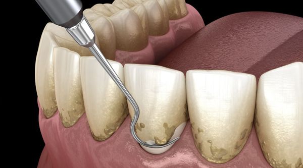 traitements de la parodontite