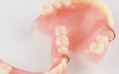 Les avantages des prothèses dentaires amovibles : une solution efficace pour remplacer les dents manquantes