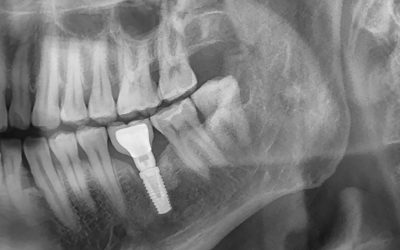 Les implants dentaires et la santé osseuse : ce que vous devez savoir