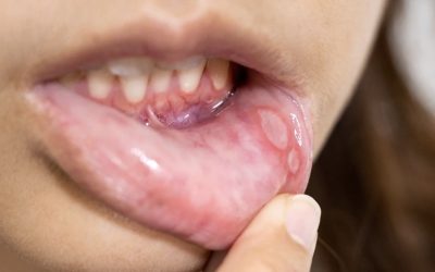 Comment gérer les aphtes et les ulcérations buccales : causes, prévention et traitements
