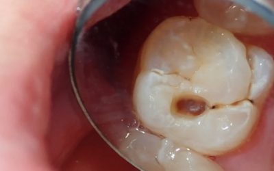 La prévention des caries chez les adultes : stratégies efficaces pour un sourire durable