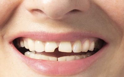 Tout savoir sur les traumatismes dentaires : comment réagir et préserver vos dents