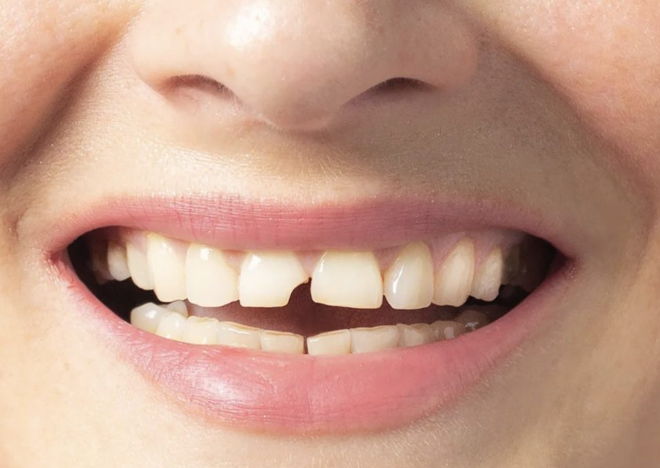 traumatismes dentaires