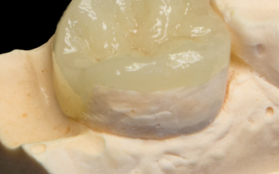 Les obturations dentaires : faut-il les réparer ou les remplacer ? Focus sur les inlays / onlays