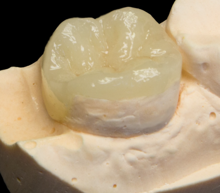 obturations dentaires