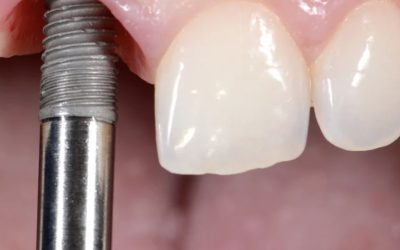 Extraction-implantation : pourquoi la zone du sourire exige une expertise spécifique ?