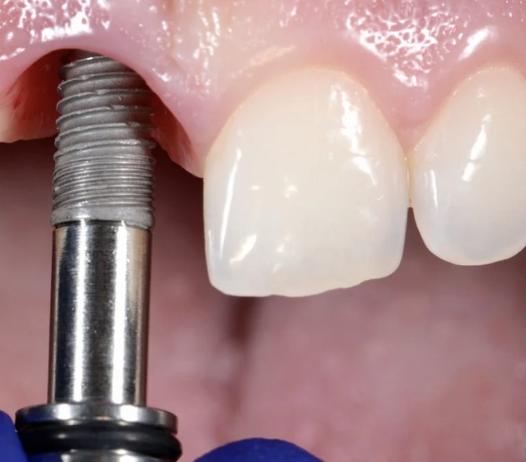 Extraction-implantation