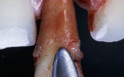 Extraction-implantation : pourquoi la zone du sourire exige une expertise spécifique ?