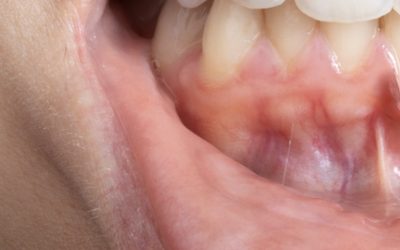 Biotype gingival : pourquoi certaines gencives sont plus fragiles que d’autres ?