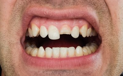 Pourquoi une dent peut casser sans carie apparente ?