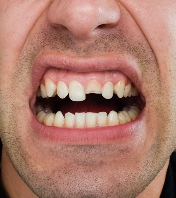 Ma dent s’est cassée