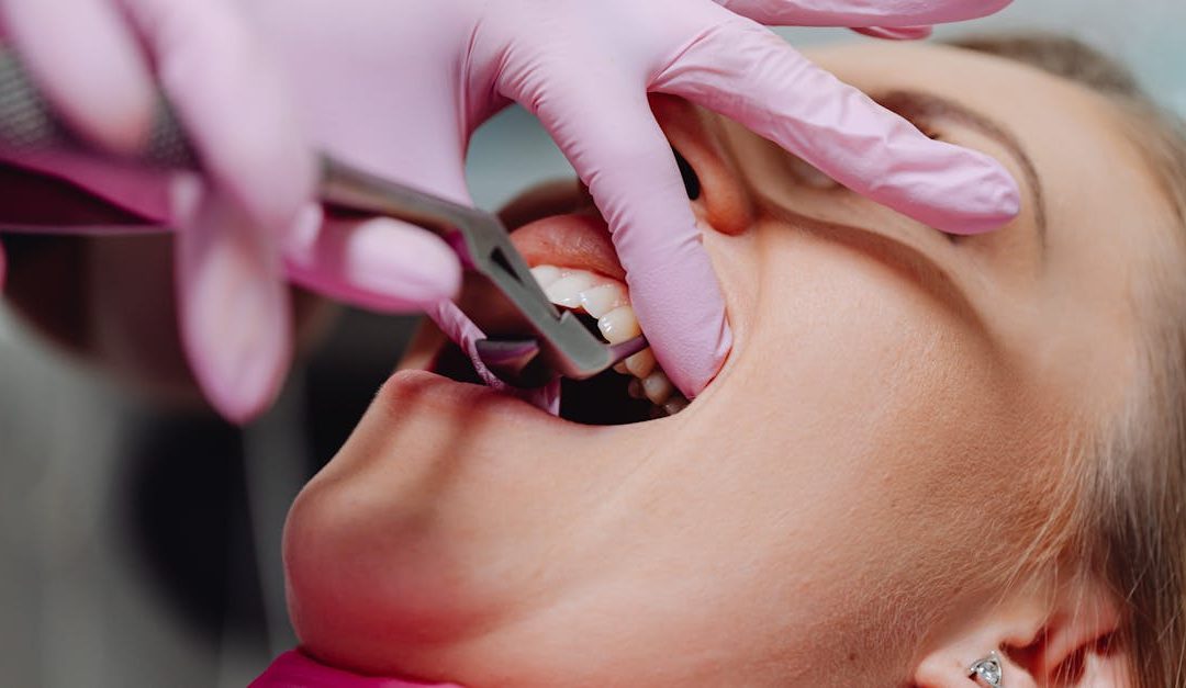 Illustration d'une carie proximale entre deux dents molaires vue en coupe