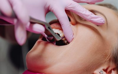 Carie entre les dents : comment elle se forme et pourquoi l&rsquo;hygiène seule ne suffit pas toujours