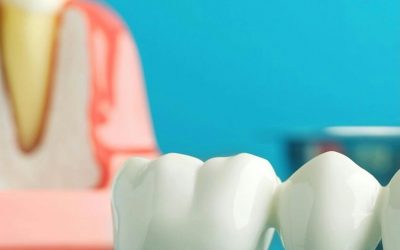 Couronne dentaire : combien de temps ça prend vraiment ?